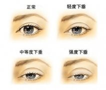 上睑下垂的临床表现以及最佳矫正时间